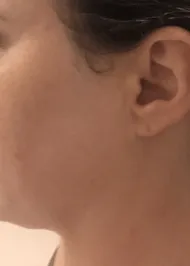 woman without acne after
